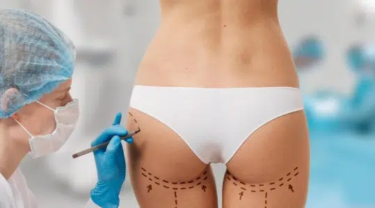 La imagen muestra a una doctora dibujando en el cuerpo de una paciente para determinar las zonas en la que realizará la lipotransferencia a glúteo